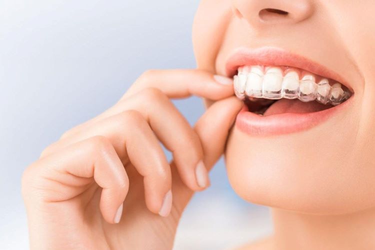 マウスピース矯正の値段はどれくらい？内訳や費用を抑える方法を紹介